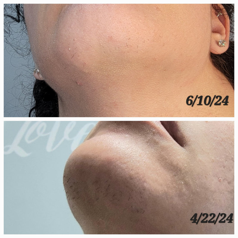 womens chin laser hair removal in frisco