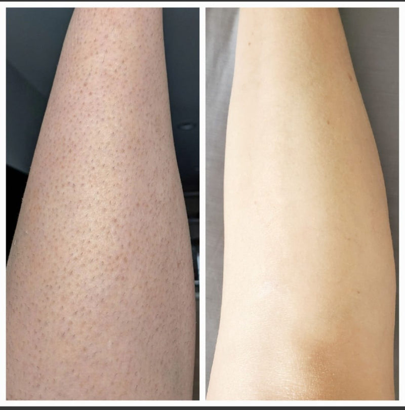 women leg laser hair removal in frisco