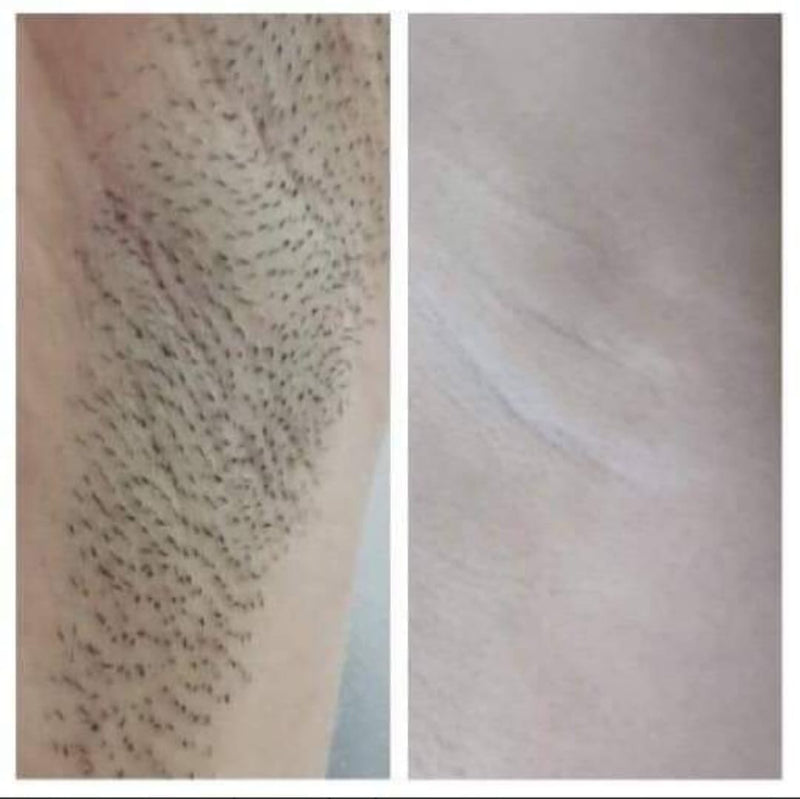 underarm laser hair removal frisco texas